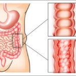 Bệnh viêm đại tràng co thắt nguyên nhân, triệu chứng và phòng ngừa