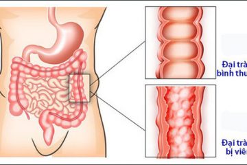 Bệnh viêm đại tràng co thắt nguyên nhân, triệu chứng và phòng ngừa